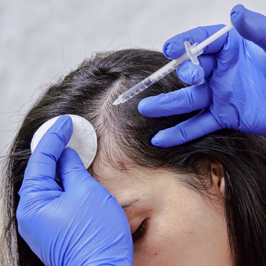 Scalp micropigmentation treatment at Glam Aesthetics, Hyderabad.