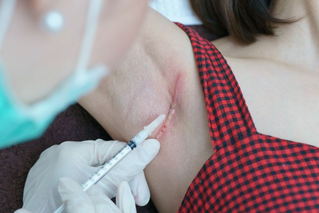 Keloid treatment at Glam Aesthetics, Hyderabad.