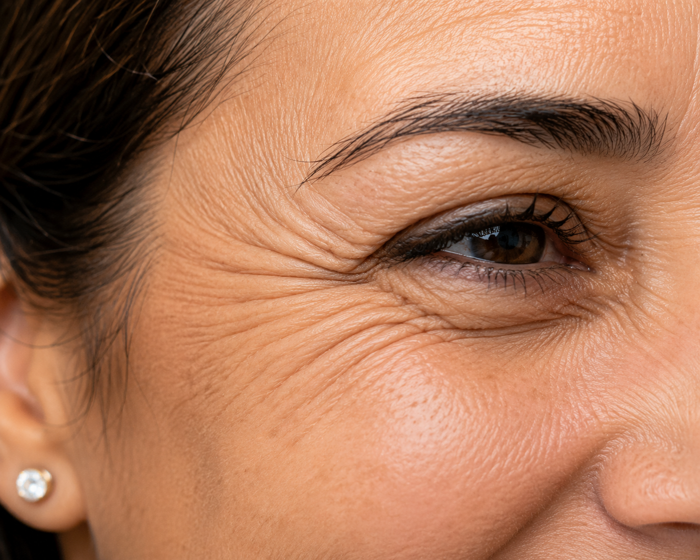 Crows feet treatment