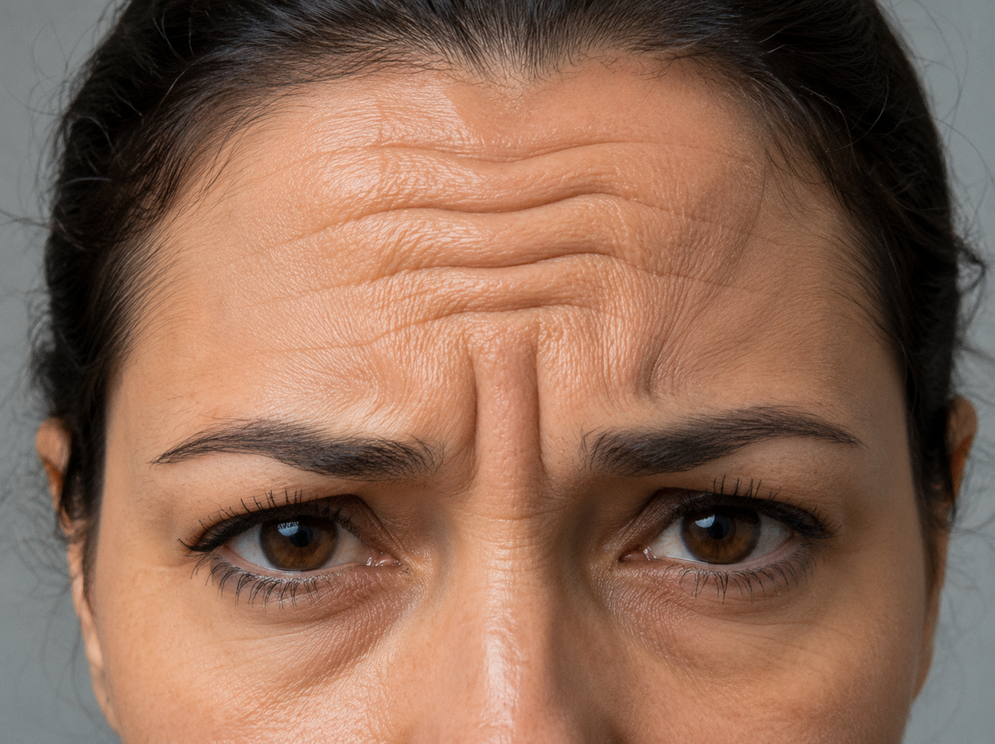 Forehead lines treatment