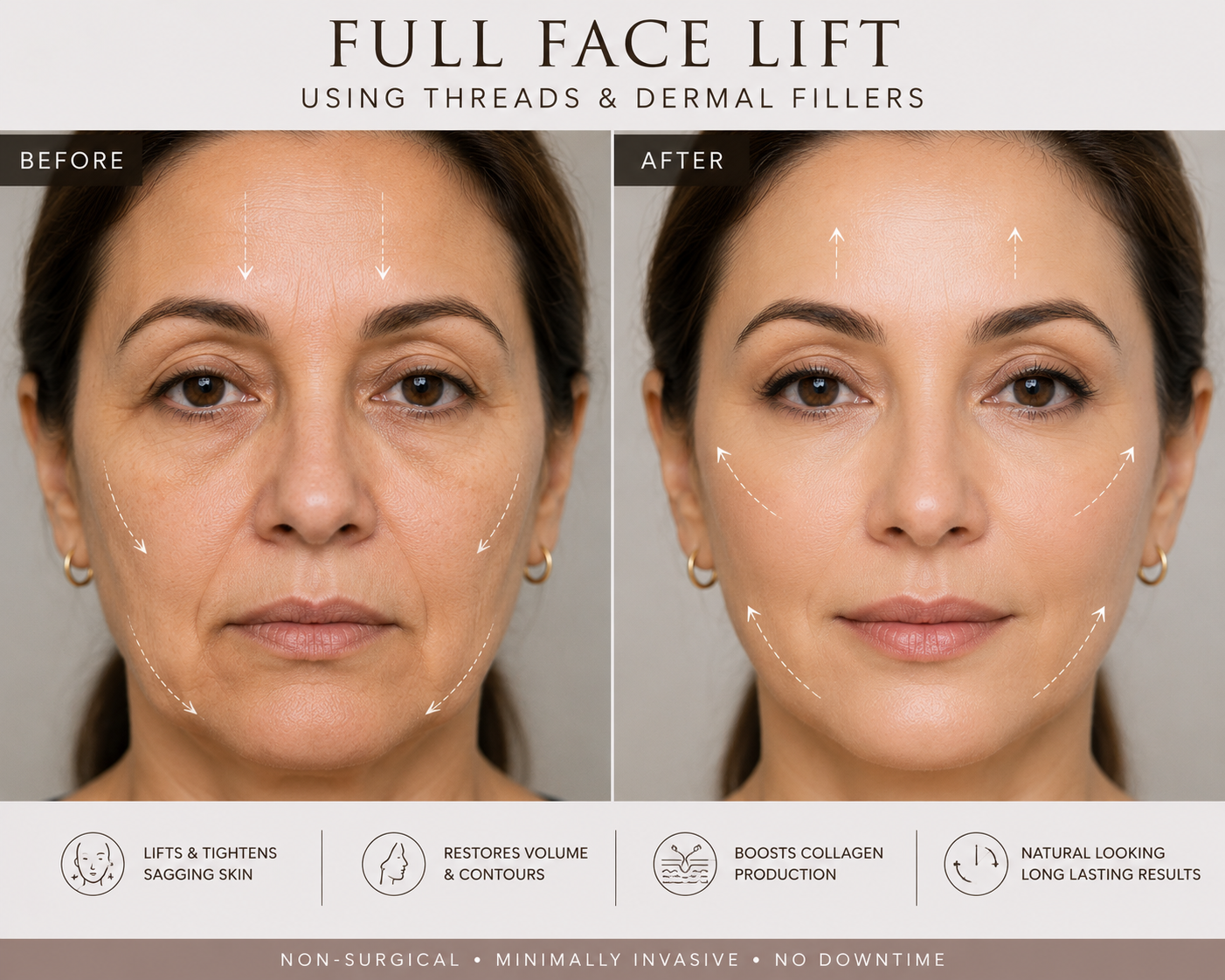 Face lifting